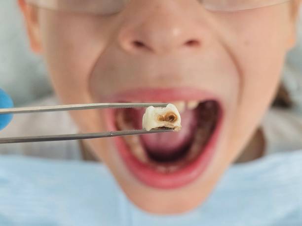 Best Emergency Tooth Extraction in Kinsley, KS